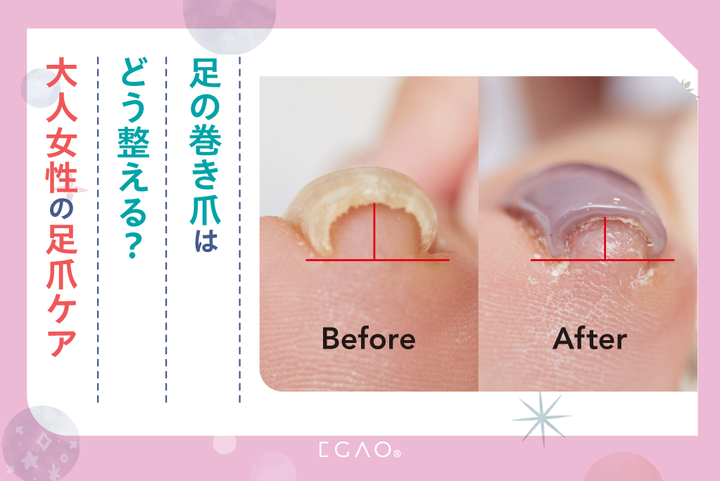 足の巻き爪はどう整える？大人女性の足爪ケア